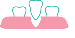 Composite Fillings at Rainbowsmilesdental