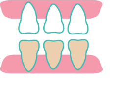 Composite Fillings at Rainbowsmilesdental