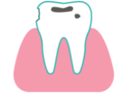 Composite Fillings at Rainbowsmilesdental