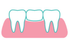 Composite Fillings at Rainbowsmilesdental