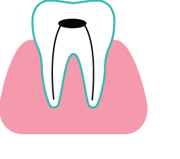 Composite Fillings at Rainbowsmilesdental