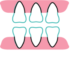 Composite Fillings at Rainbowsmilesdental